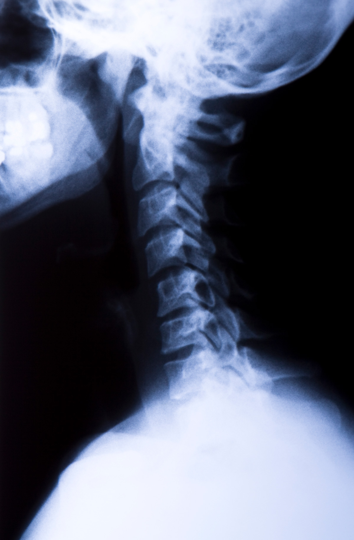 contact sports causing more severe symptoms of neck injuries causing limited range of motion